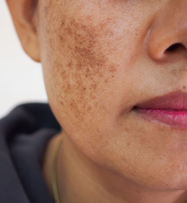 melasma (hyperpigmentation)