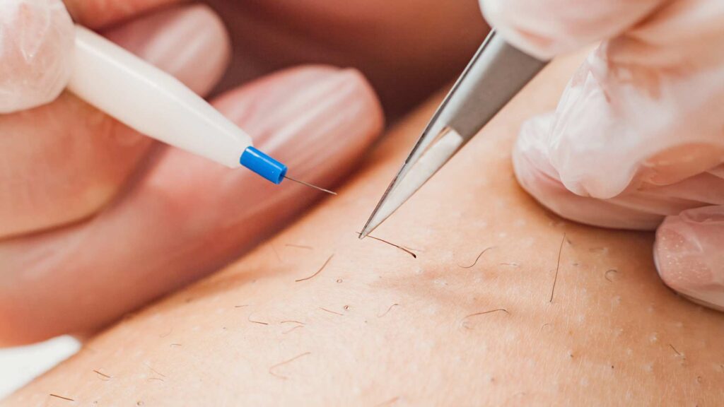 electrolysis hair removal